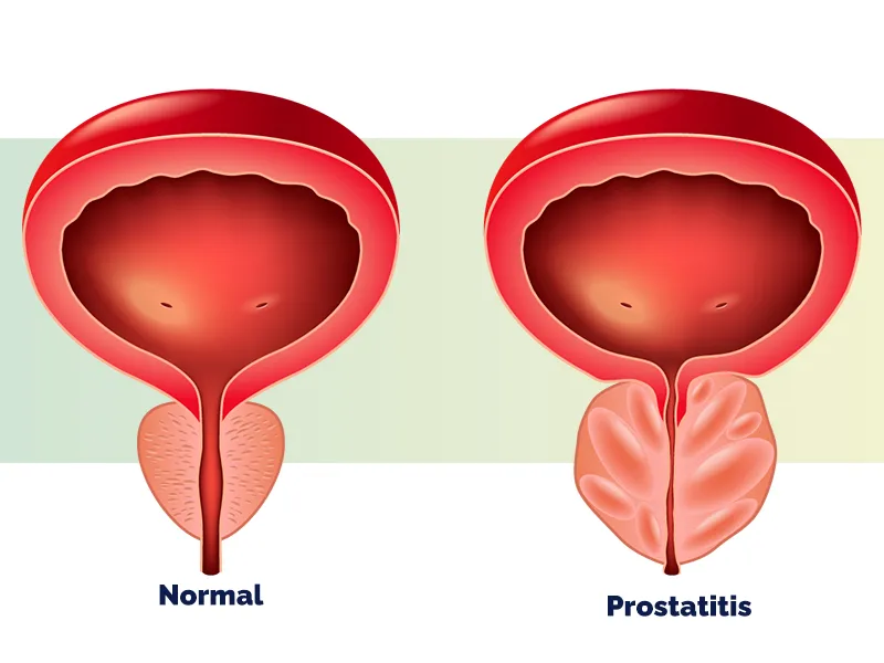 block-Prostatitis