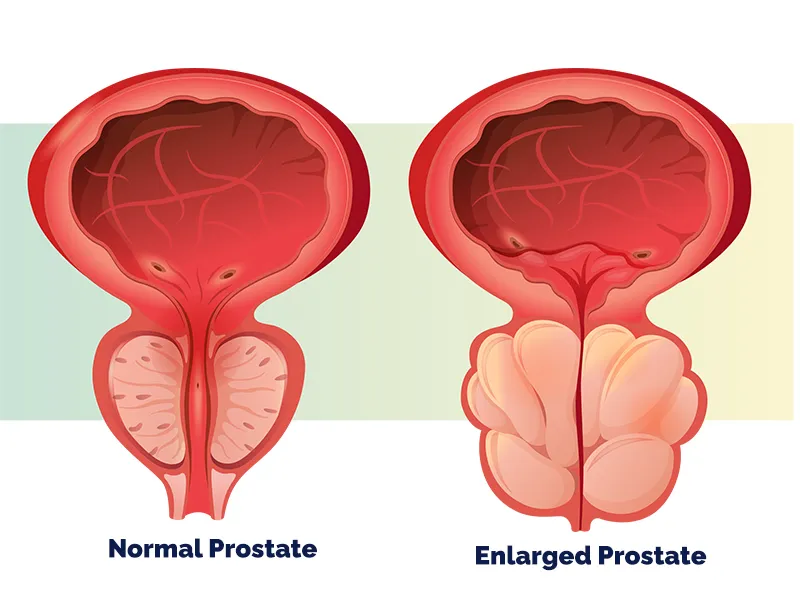 block-enlarged-prostate