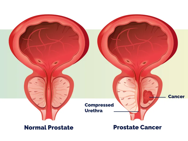 block-prostate-cancer