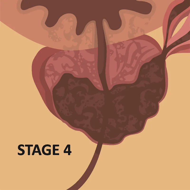 block-stage-four
