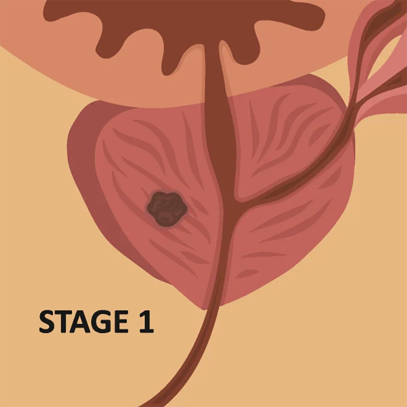block-stage-one