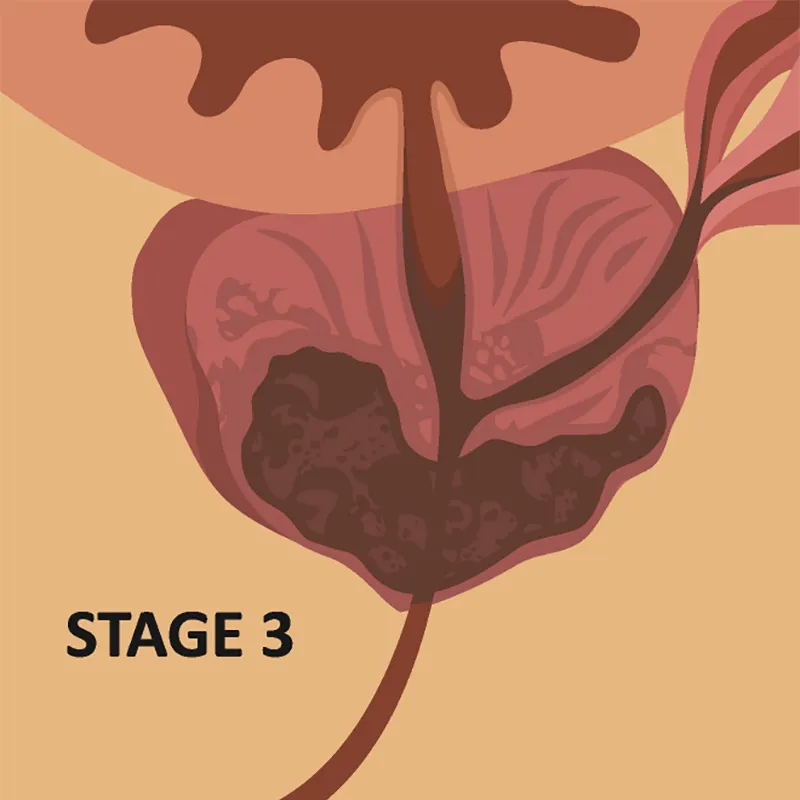 block-stage-three