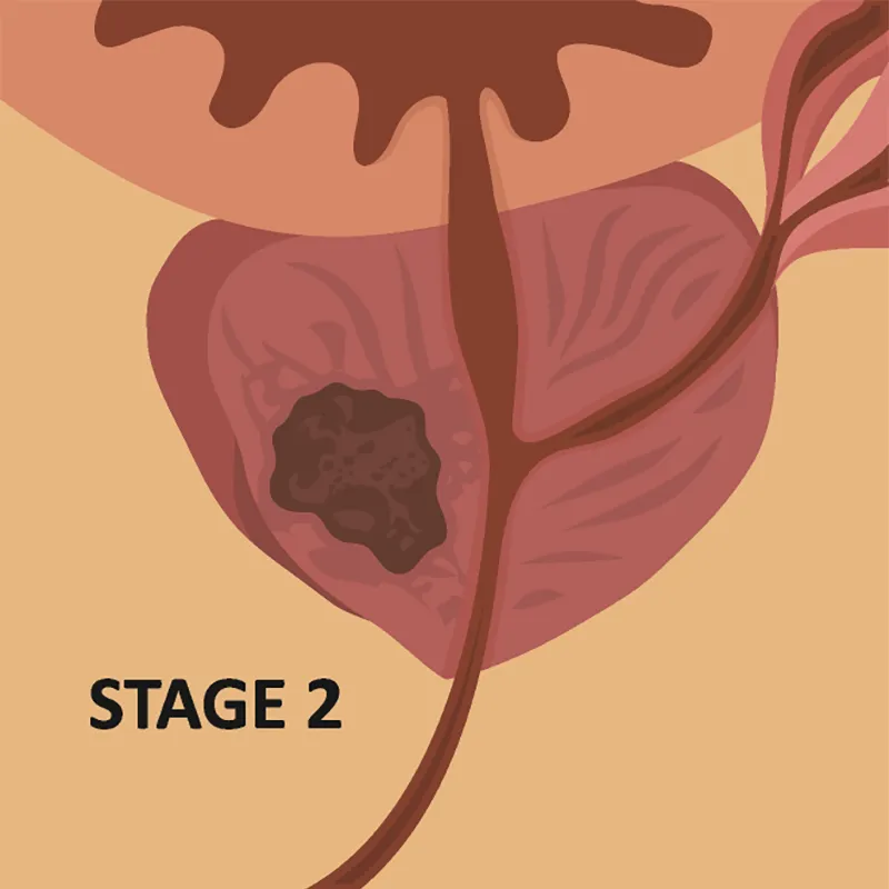 block-stage-two
